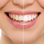 Blanqueamiento dental