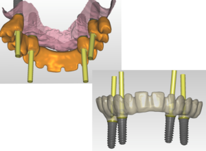 Implantes cigomáticos planificación 3D