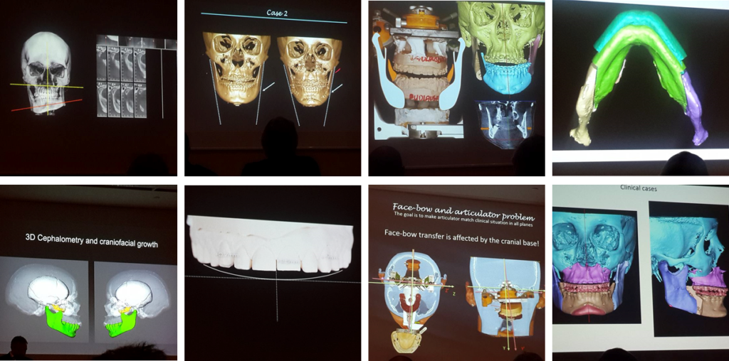 planificación virtual 3D de la Cirugía Ortognática