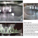 caso de implantes dentales Maxilonet