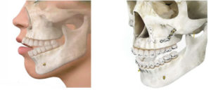 mordida abierta- maxilonet- cirugía maxilofacial