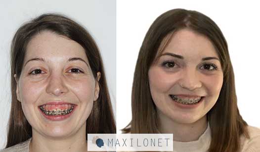 Maxilonet-Maloclusión y deformidad dentofacial