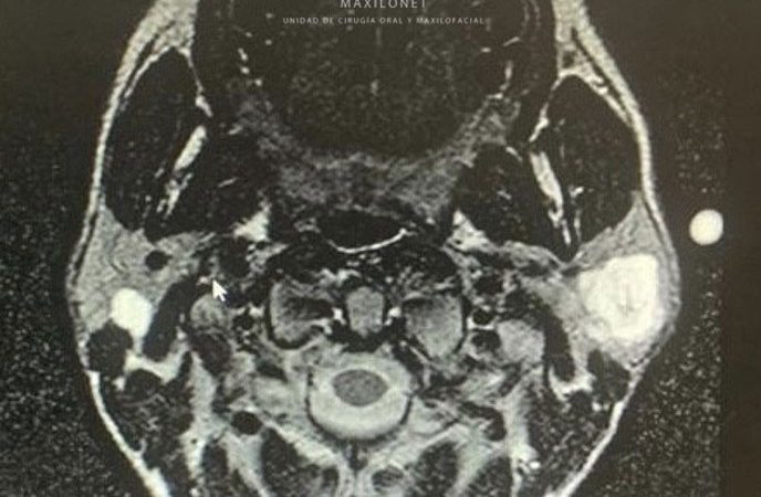 Caso: Tumor de parótida