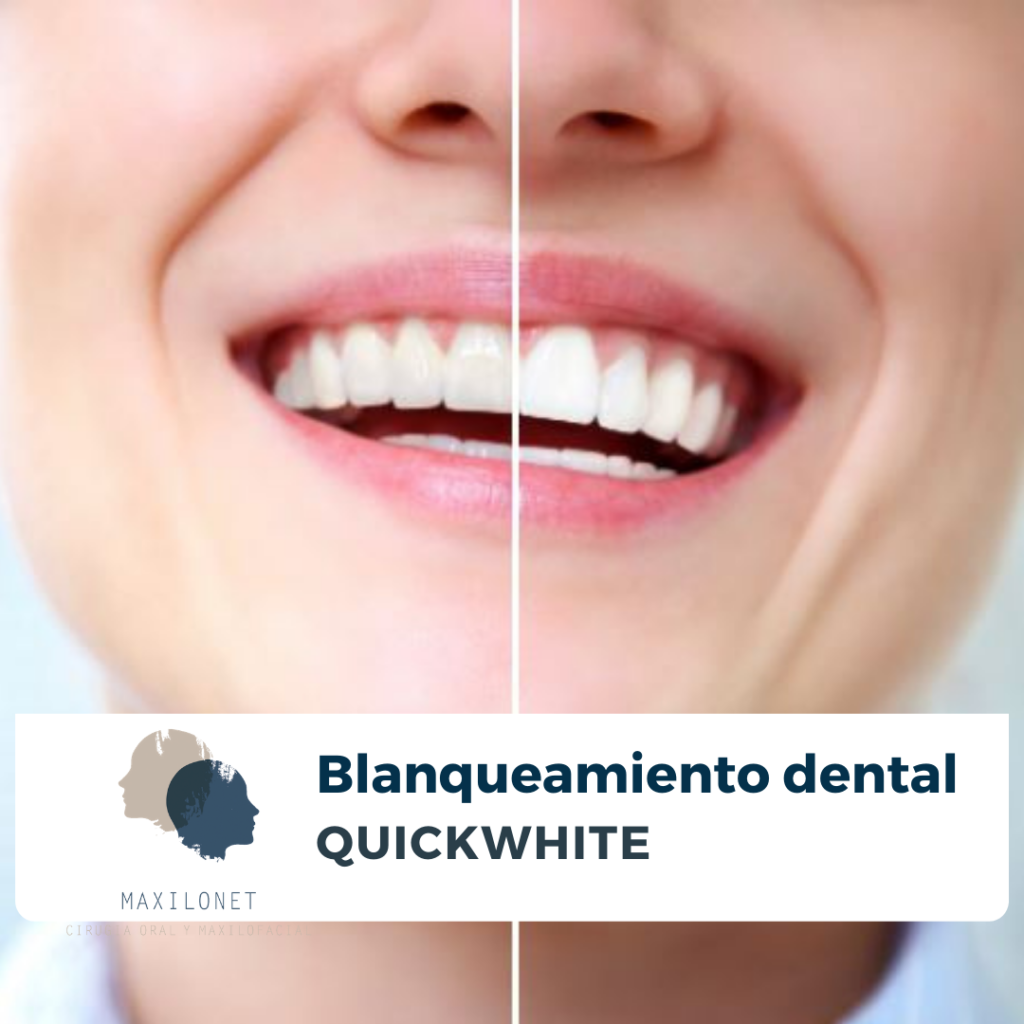 Blanqueamiento dental en Barcelona en Maxilonet Hospital Universitari Dexeus